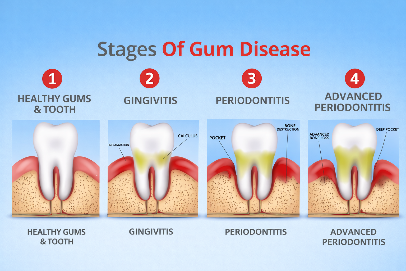 Effects of tea and coffee on teeth